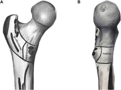 Morphological analysis of posterior-medial intertrochanteric fracture patterns using fracture-mapping technique